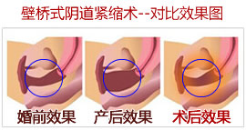 津门医院阴道紧缩效果图